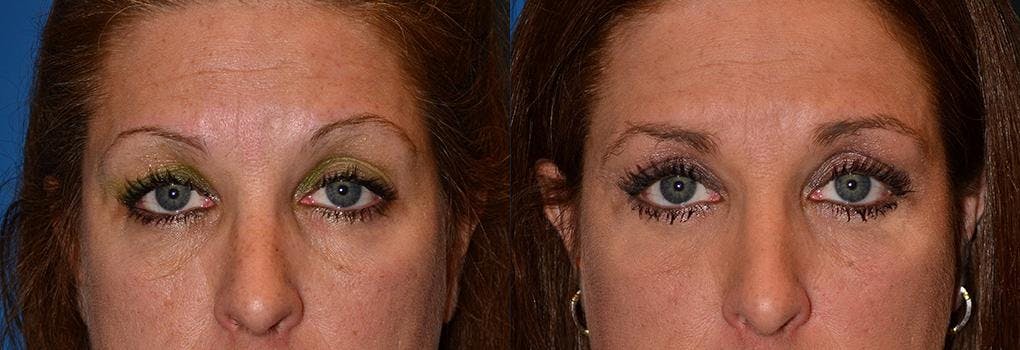 Skin Resurfacing Before & After Gallery - Patient 122406783 - Image 1