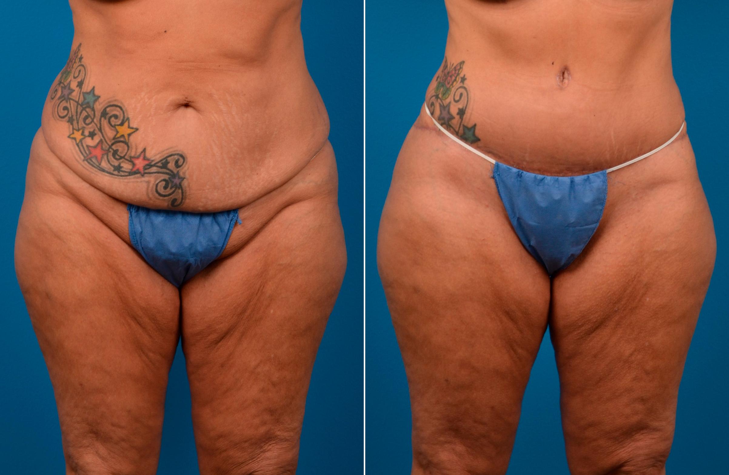 Hidden Tummy Tuck Before & After Gallery - Patient 112008 - Image 1