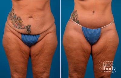 Hidden Tummy Tuck Before & After Gallery - Patient 112008 - Image 1