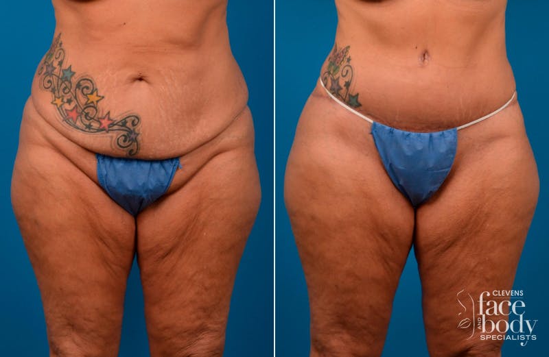 Hidden Tummy Tuck Before & After Gallery - Patient 112008 - Image 1