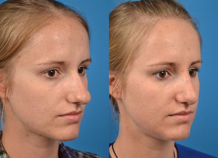 Rhinoplasty Before & After Gallery - Patient 122406782 - Image 2