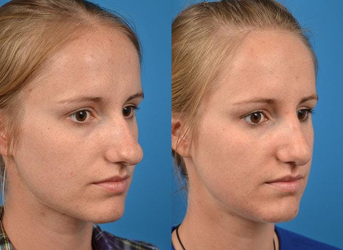 Rhinoplasty Before & After Gallery - Patient 122406782 - Image 2