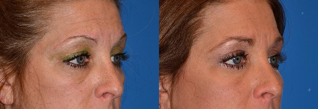 Skin Resurfacing Before & After Gallery - Patient 122406783 - Image 2