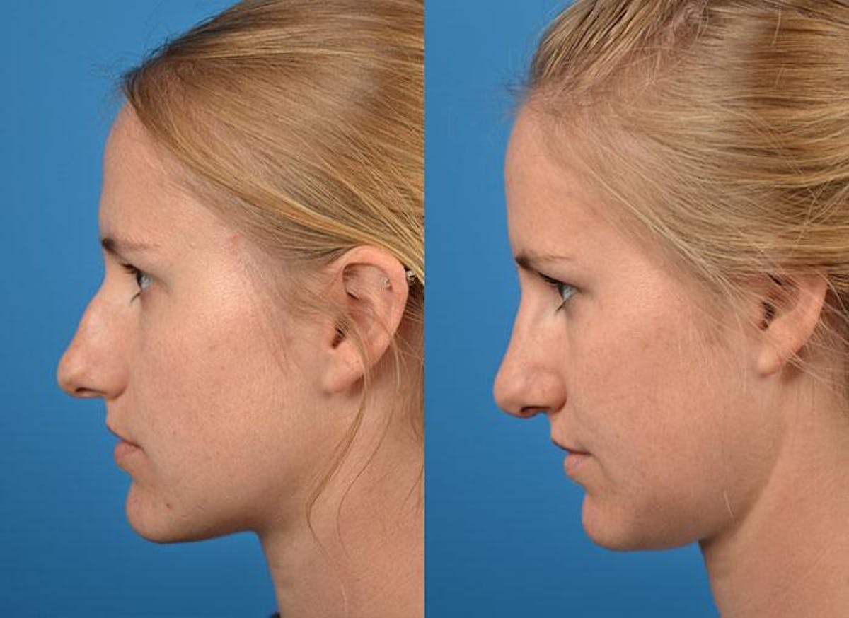 Rhinoplasty Before & After Gallery - Patient 122406782 - Image 3