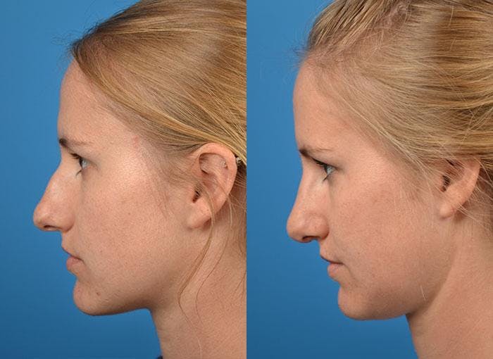 Rhinoplasty Before & After Gallery - Patient 122406782 - Image 3