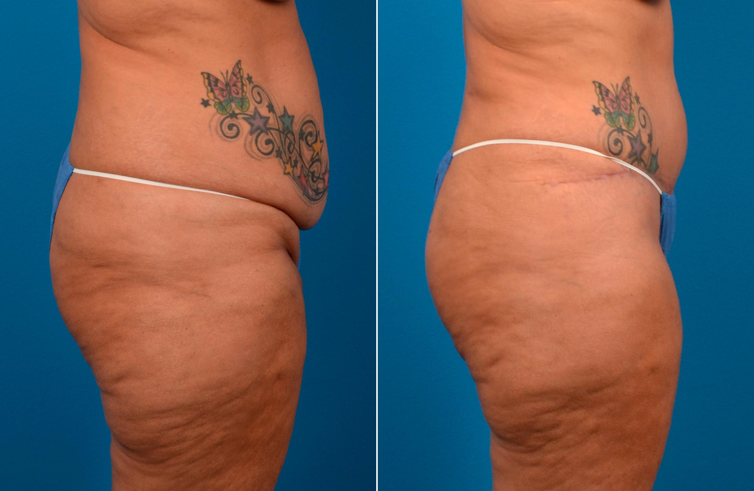 Hidden Tummy Tuck Before & After Gallery - Patient 112008 - Image 2