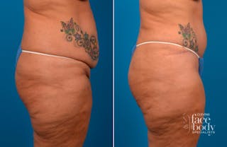 Hidden Tummy Tuck Before & After Gallery - Patient 112008 - Image 2