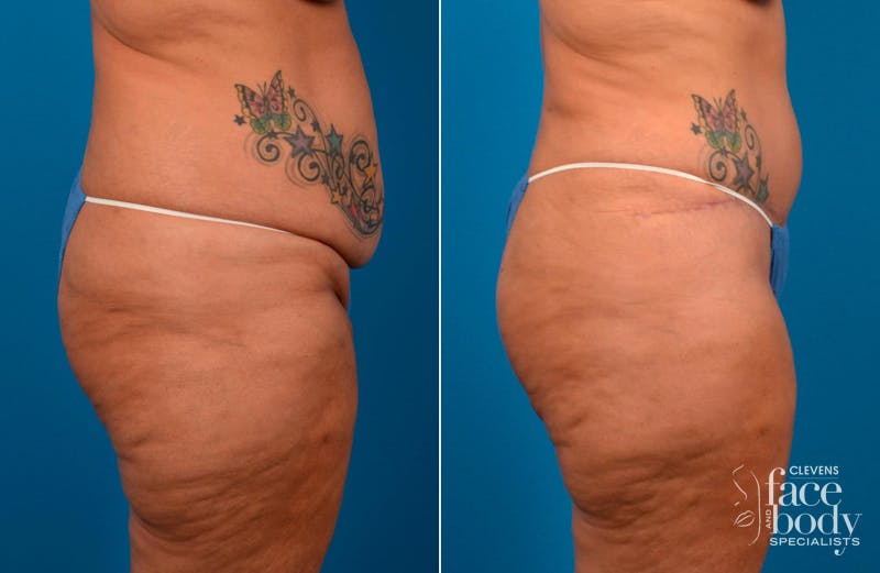 Hidden Tummy Tuck Before & After Gallery - Patient 112008 - Image 2