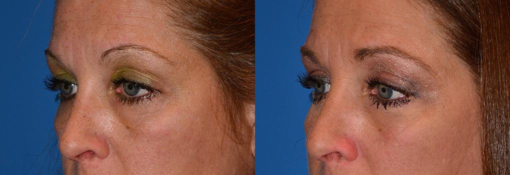 Skin Resurfacing Before & After Gallery - Patient 122406783 - Image 3