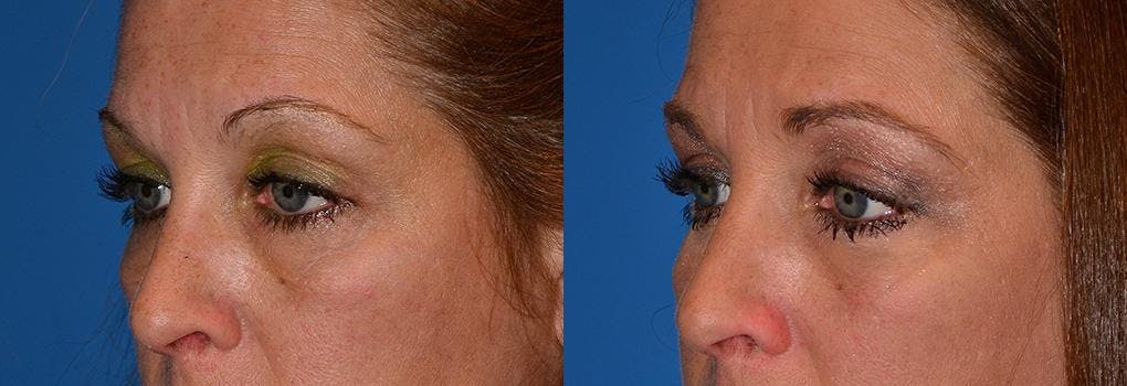 Skin Resurfacing Before & After Gallery - Patient 122406783 - Image 3