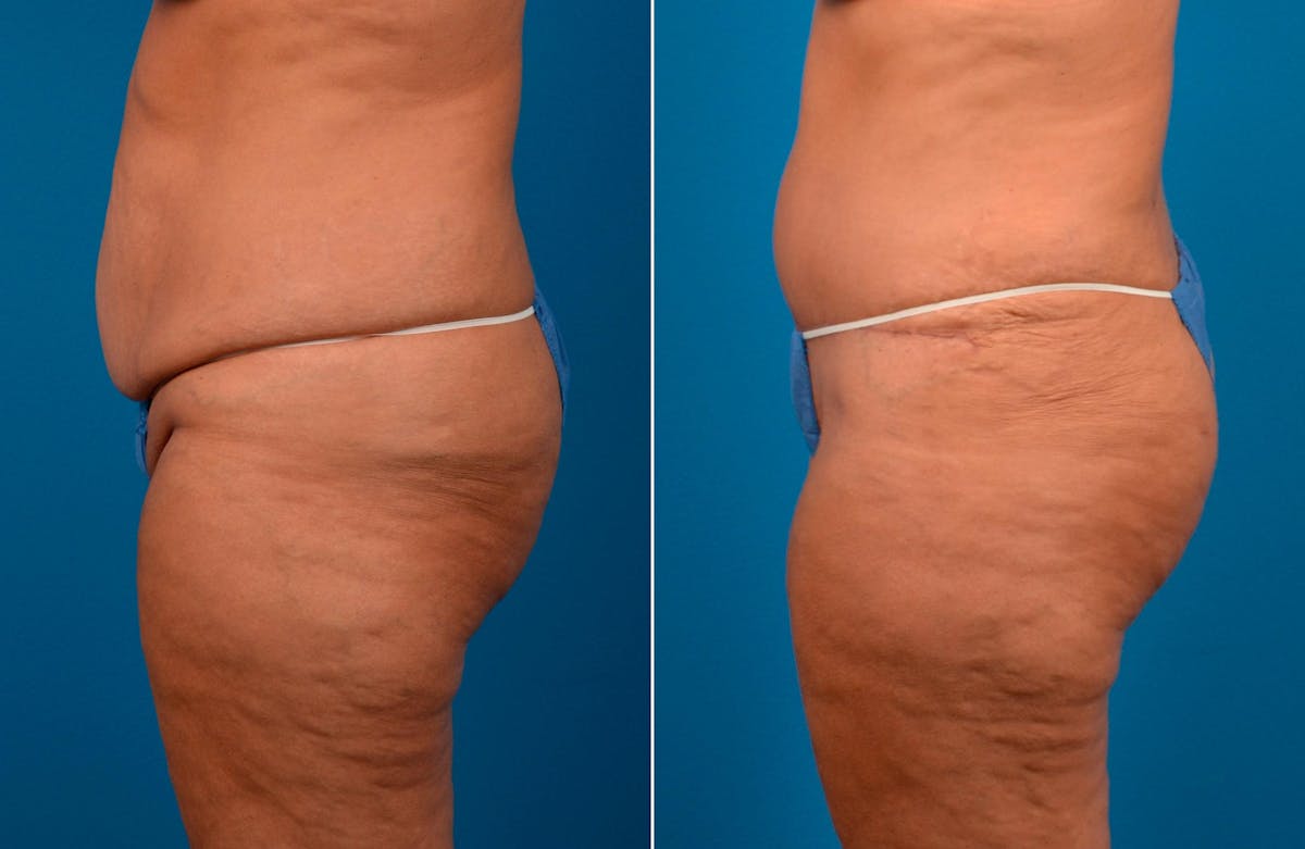Hidden Tummy Tuck Before & After Gallery - Patient 112008 - Image 3