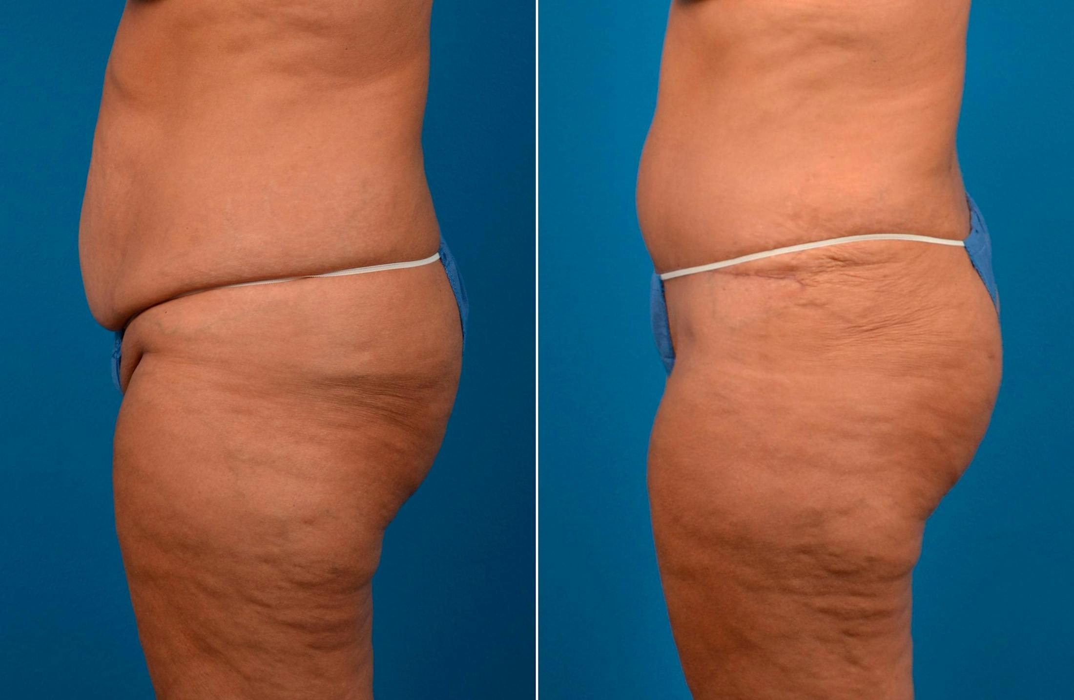 Tummy Tuck Gallery - Patient 122406785 - Image 3