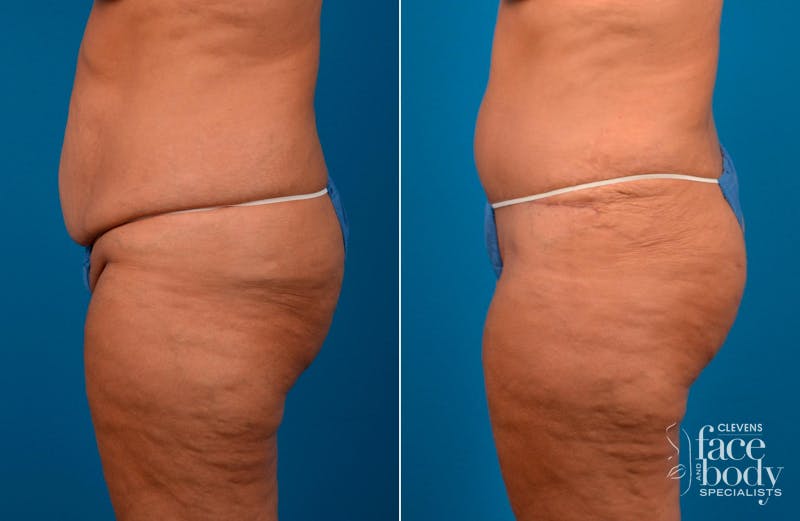 Hidden Tummy Tuck Before & After Gallery - Patient 112008 - Image 3