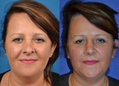 Rhinoplasty Before & After Gallery - Patient 122406787 - Image 1