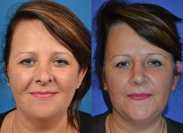 Rhinoplasty Before & After Gallery - Patient 122406787 - Image 1