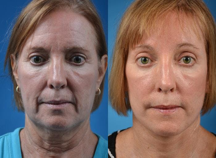 Skin Resurfacing Before & After Gallery - Patient 122406786 - Image 1