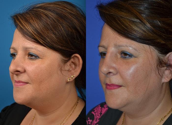 Rhinoplasty Before & After Gallery - Patient 122406787 - Image 2
