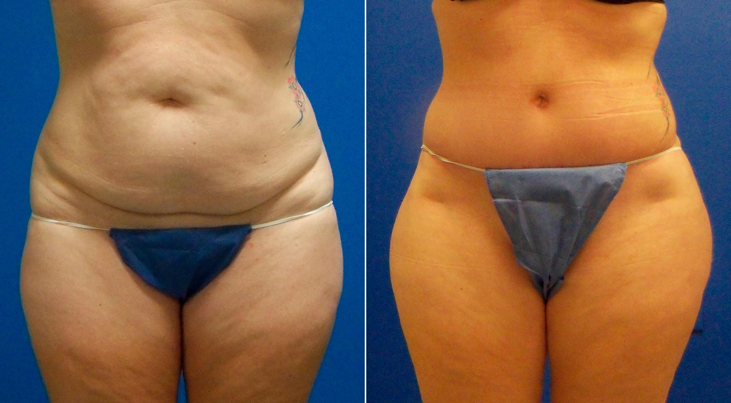 Hidden Tummy Tuck Before & After Gallery - Patient 181931 - Image 1