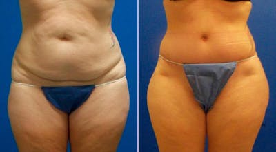 Hidden Tummy Tuck Before & After Gallery - Patient 181931 - Image 1