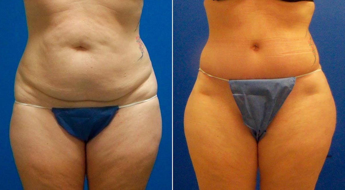 Tummy Tuck Before & After Gallery - Patient 122406788 - Image 1
