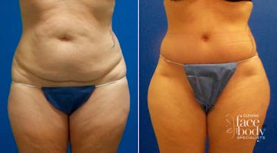 Hidden Tummy Tuck Before & After Gallery - Patient 181931 - Image 1