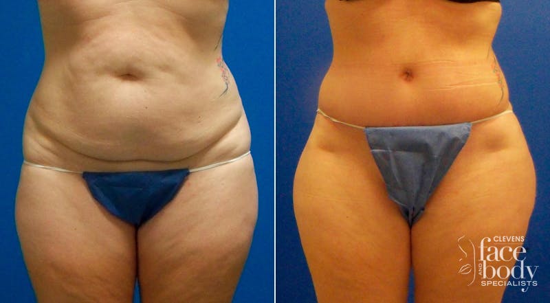 Hidden Tummy Tuck Before & After Gallery - Patient 181931 - Image 1