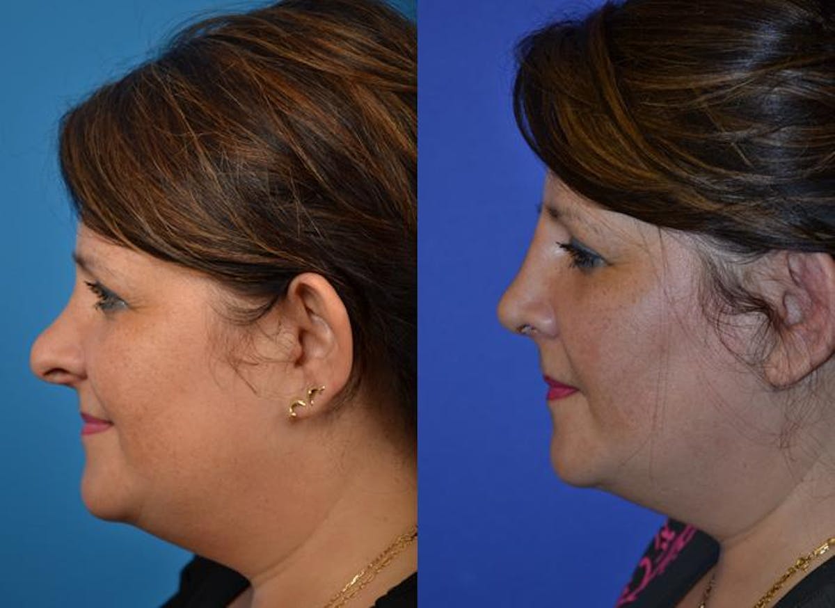 Rhinoplasty Before & After Gallery - Patient 122406787 - Image 3