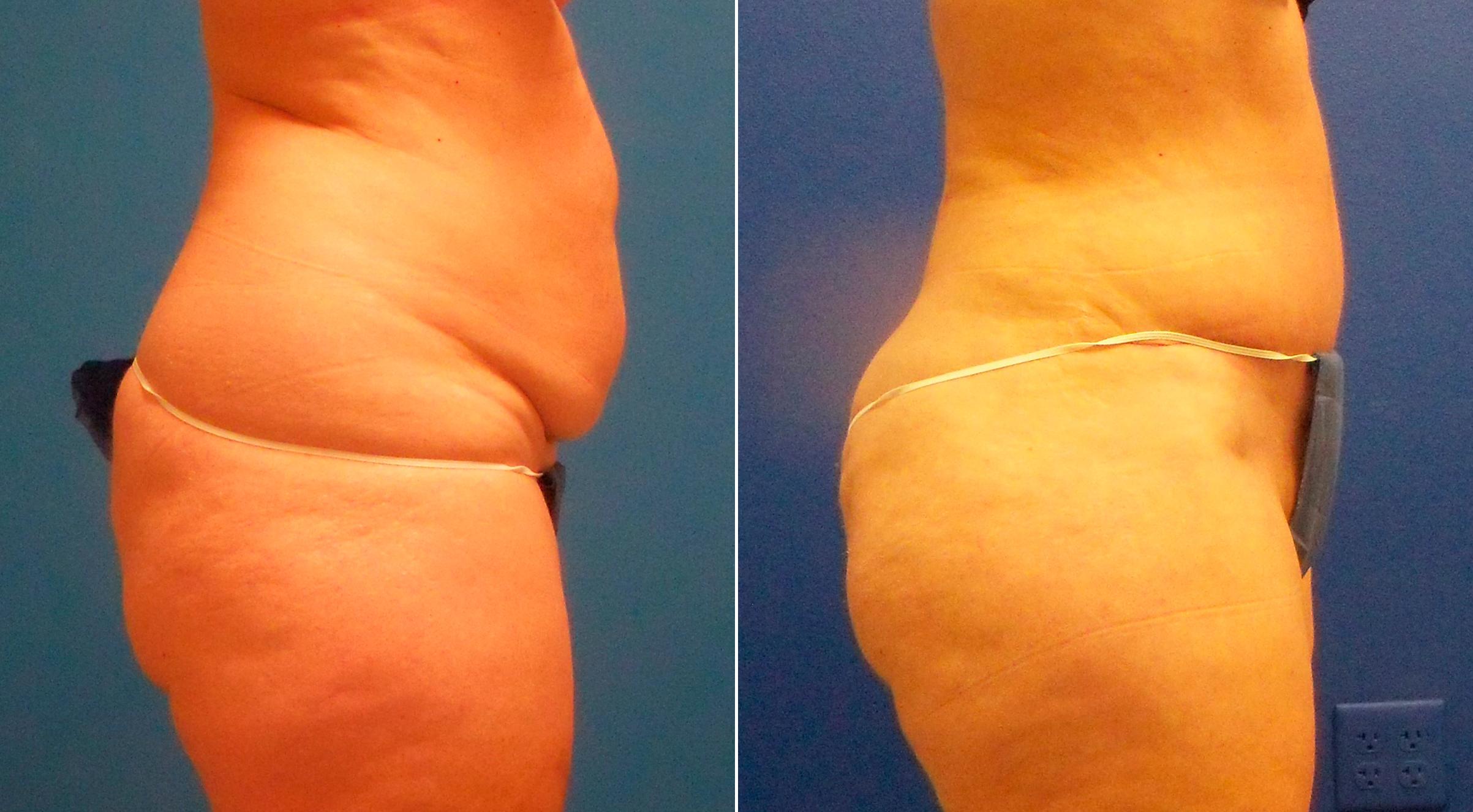 Hidden Tummy Tuck Before & After Gallery - Patient 181931 - Image 2