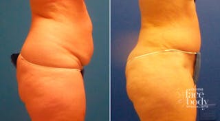 Hidden Tummy Tuck Before & After Gallery - Patient 181931 - Image 2
