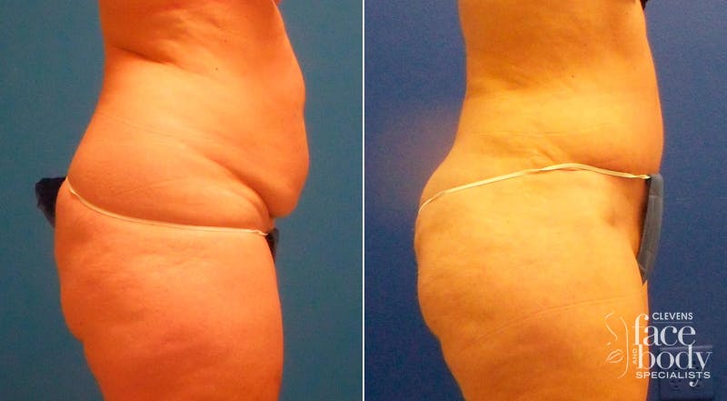 Hidden Tummy Tuck Before & After Gallery - Patient 181931 - Image 2