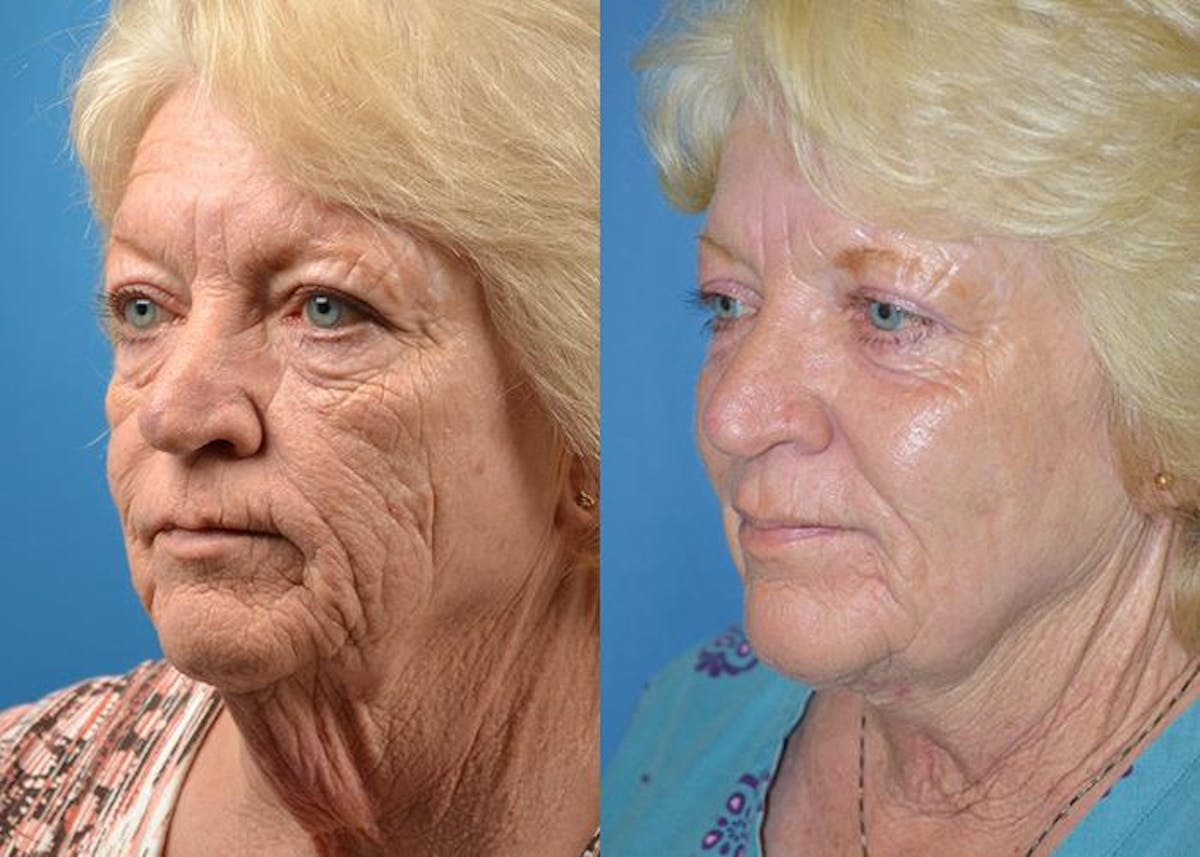 Skin Resurfacing Before & After Gallery - Patient 122406790 - Image 2