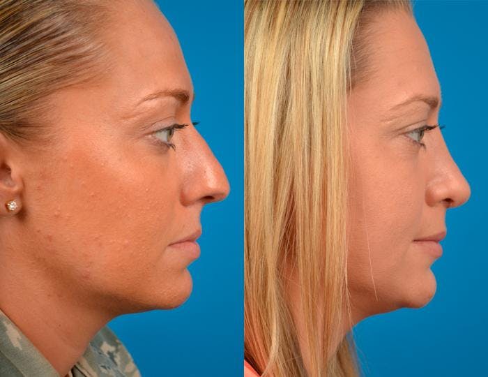 Rhinoplasty Before & After Gallery - Patient 122406789 - Image 2
