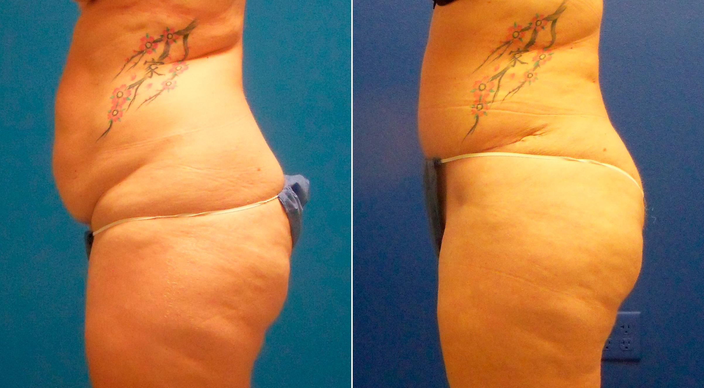 Hidden Tummy Tuck Before & After Gallery - Patient 181931 - Image 3