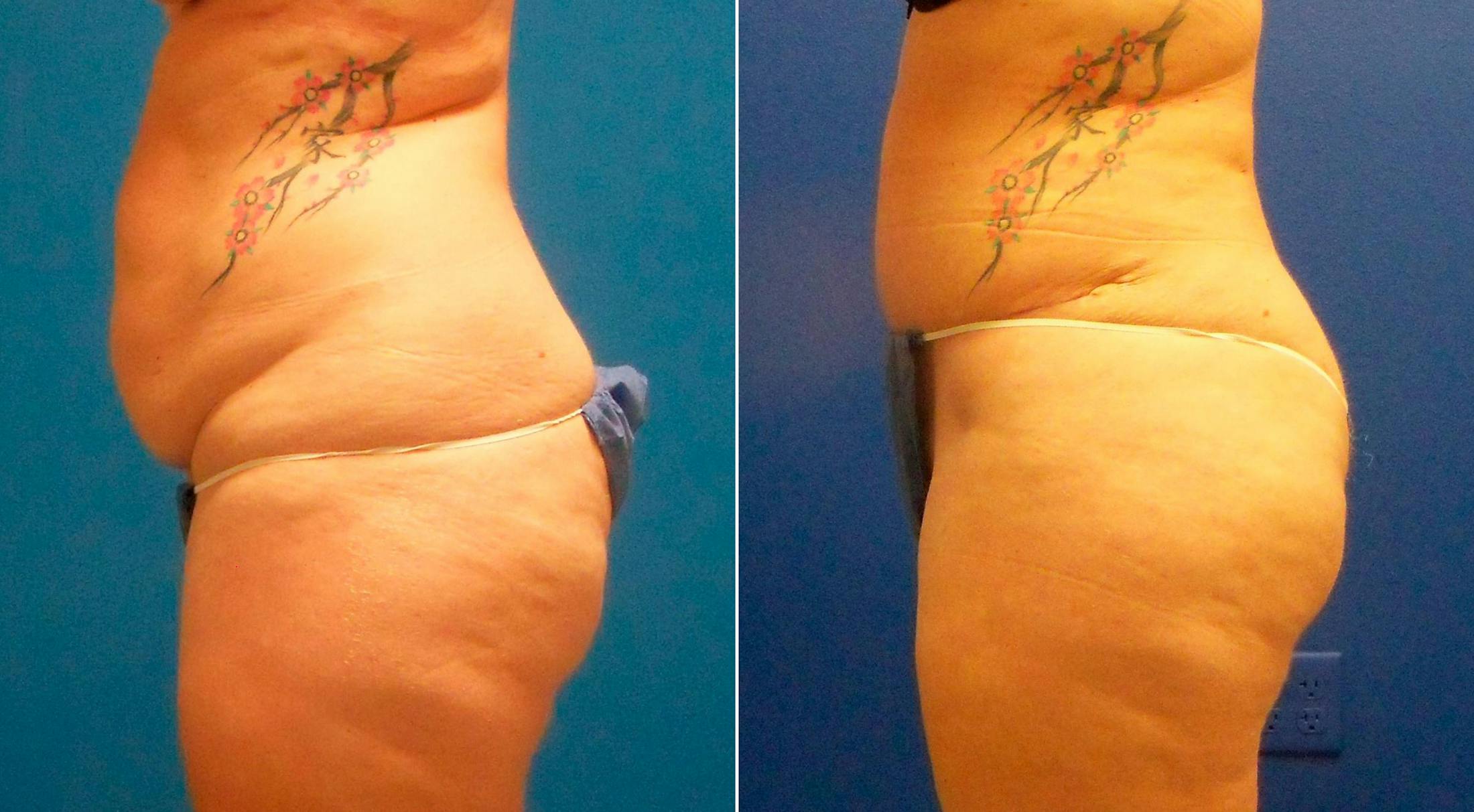 Tummy Tuck Gallery - Patient 122406788 - Image 3