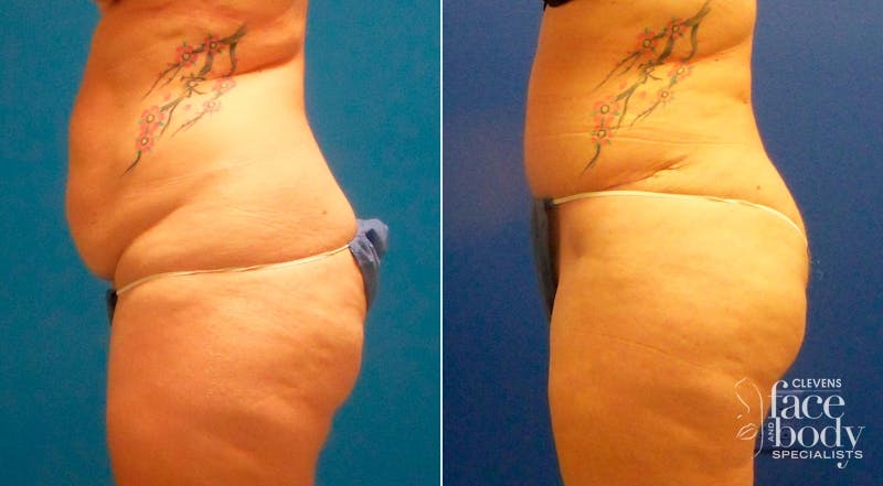 Hidden Tummy Tuck Before & After Gallery - Patient 181931 - Image 3