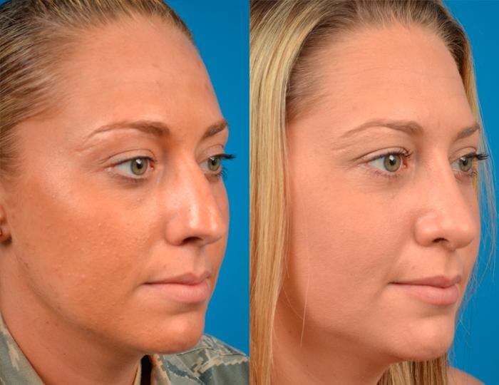 Rhinoplasty Before & After Gallery - Patient 122406789 - Image 3