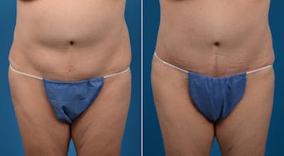 Tummy Tuck Before & After Gallery - Patient 417373 - Image 1