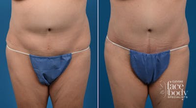Hidden Tummy Tuck Before & After Gallery - Patient 284119 - Image 1