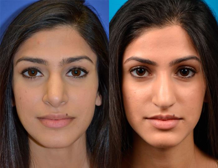Rhinoplasty Before & After Gallery - Patient 122406791 - Image 1