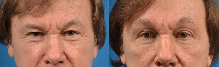 Skin Resurfacing Before & After Gallery - Patient 122406792 - Image 1