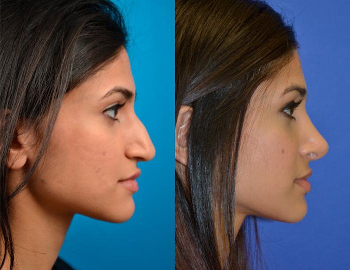 Rhinoplasty Before & After Gallery - Patient 122406791 - Image 2
