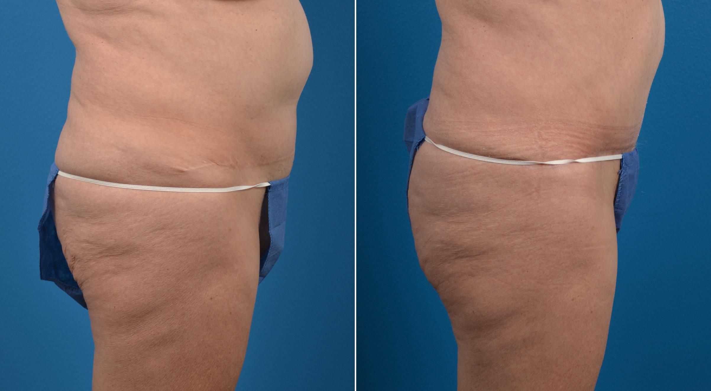 Hidden Tummy Tuck Before & After Gallery - Patient 284119 - Image 2