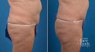 Hidden Tummy Tuck Before & After Gallery - Patient 284119 - Image 2