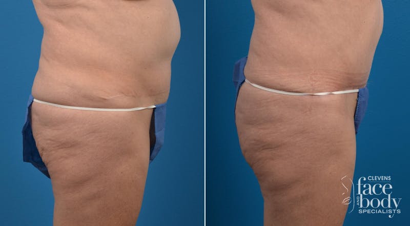 Hidden Tummy Tuck Before & After Gallery - Patient 284119 - Image 2