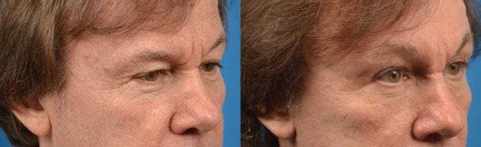 Skin Resurfacing Before & After Gallery - Patient 122406792 - Image 2