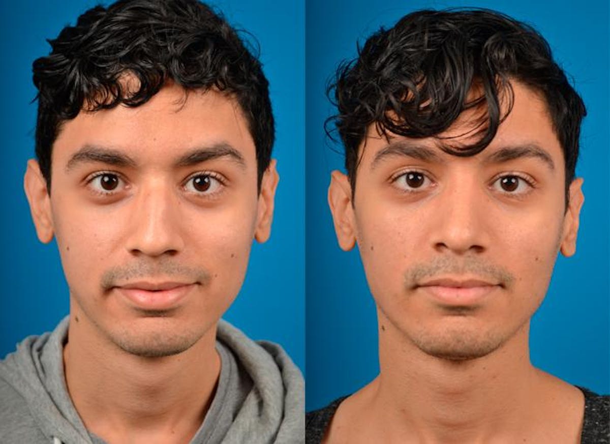 Rhinoplasty Before & After Gallery - Patient 122406796 - Image 1