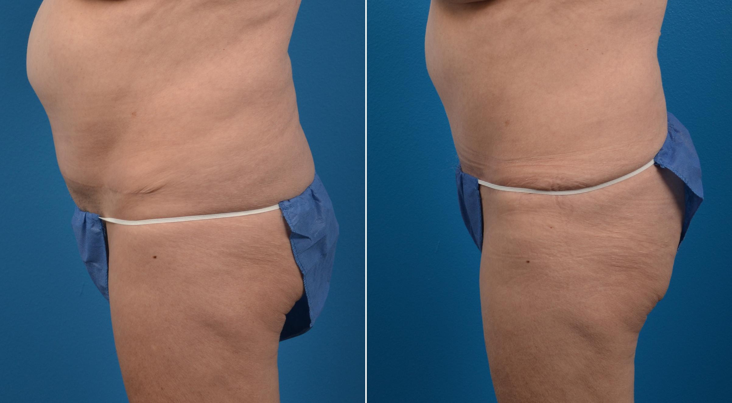 Hidden Tummy Tuck Before & After Gallery - Patient 284119 - Image 3