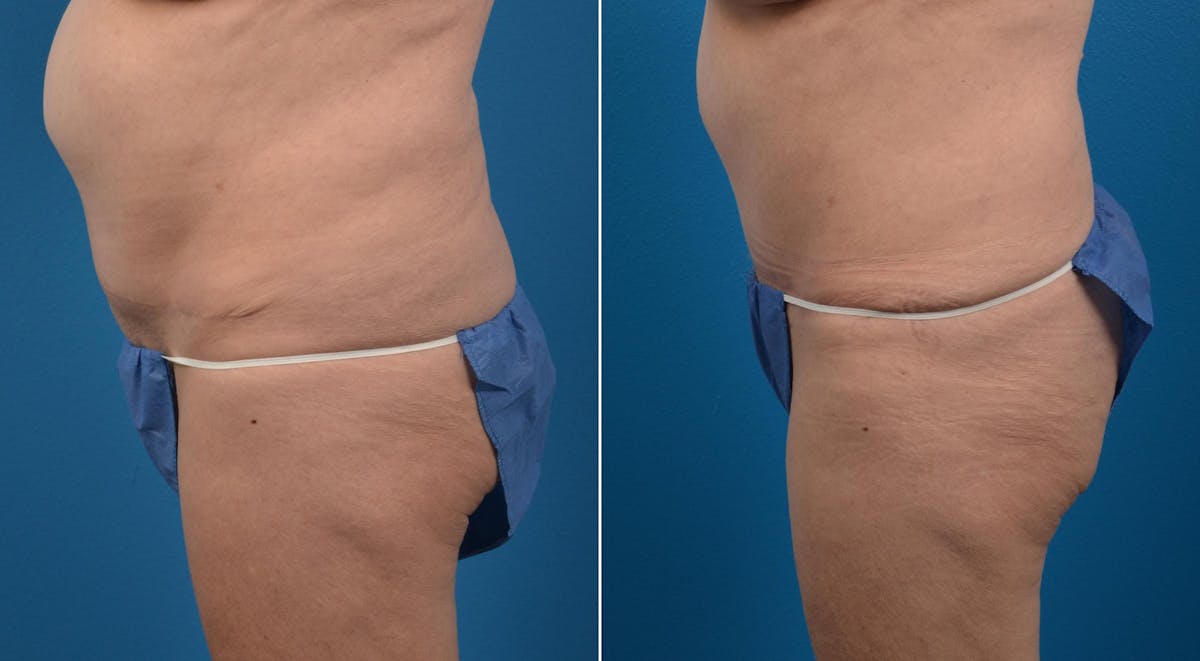 Tummy Tuck Before & After Gallery - Patient 417373 - Image 3
