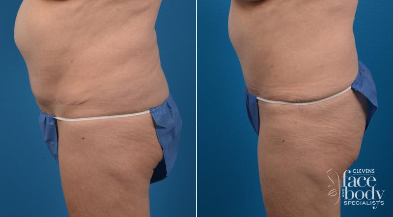 Hidden Tummy Tuck Before & After Gallery - Patient 284119 - Image 3
