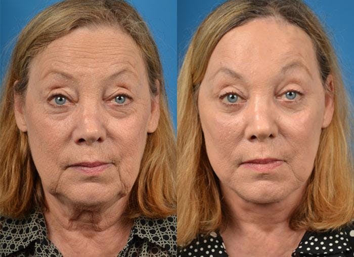 Skin Resurfacing Before & After Gallery - Patient 122406795 - Image 1